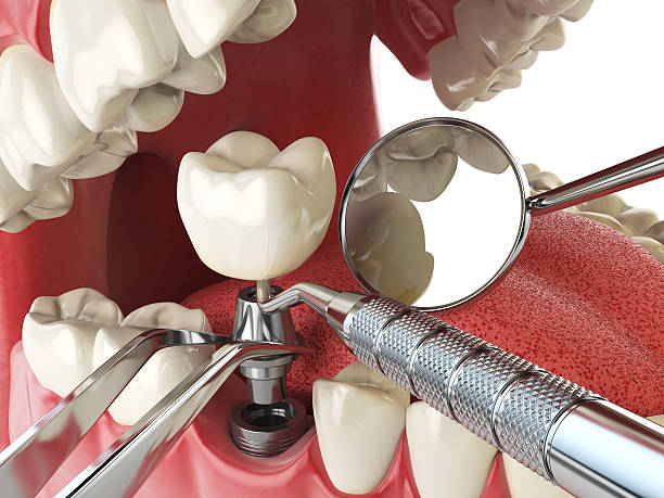 Emergency Dental Filling Replacement in WY